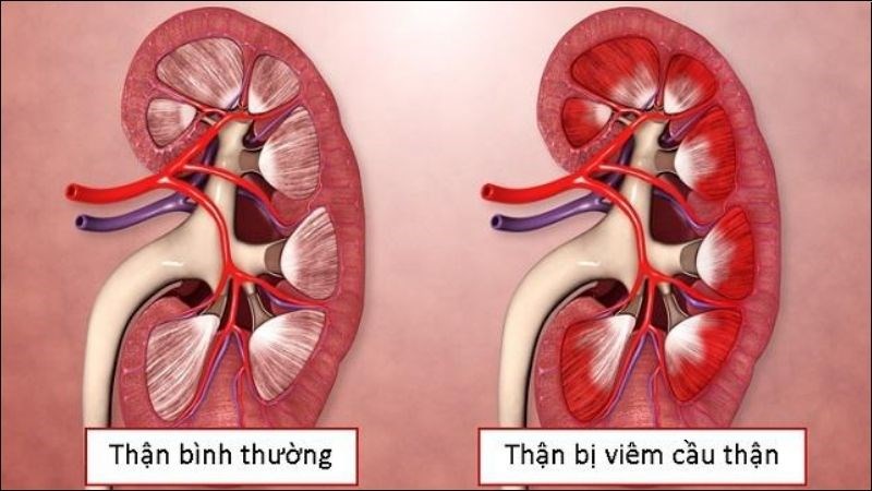 Bé gái 12 tuổi phải chạy thận suốt đời thói quen ăn uống nhiều người Việt mắc phải - Ảnh 3.