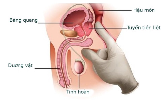 Hai cha con đều phát hiện mắc ung thư trong 1 tháng, chuyên gia khuyến cáo nam giới nhất định phải làm điều này để phòng bệnh- Ảnh 2.