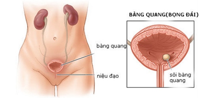 Thanh niên 26 tuổi bị ung thư bàng quang thừa nhận có 1 thói quen nhiều nam giới Việt mắc phải- Ảnh 4.