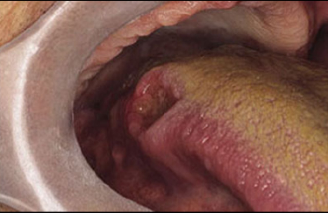 12 câu hỏi thường gặp về bệnh ung thư lưỡi- Ảnh 1.