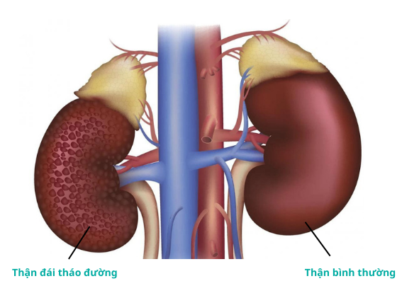 Ca sĩ Siu Black bị biến chứng thận do bệnh tiểu đường, căn bệnh cô mắc nguy hiểm thế nào? - Ảnh 3.