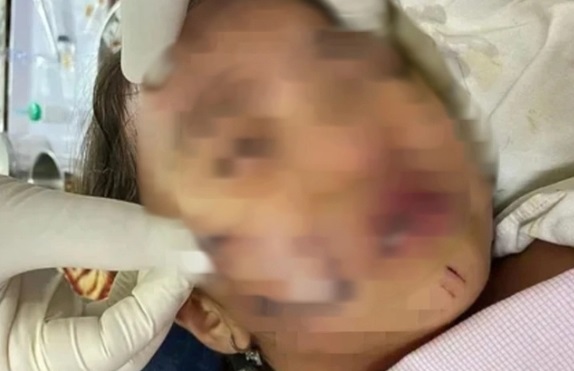 Đang chơi, bé gái 11 tuổi ở Phú Thọ bất ngờ bị chó hàng xóm cắn trọng thương vùng đầu, gáy- Ảnh 2.
