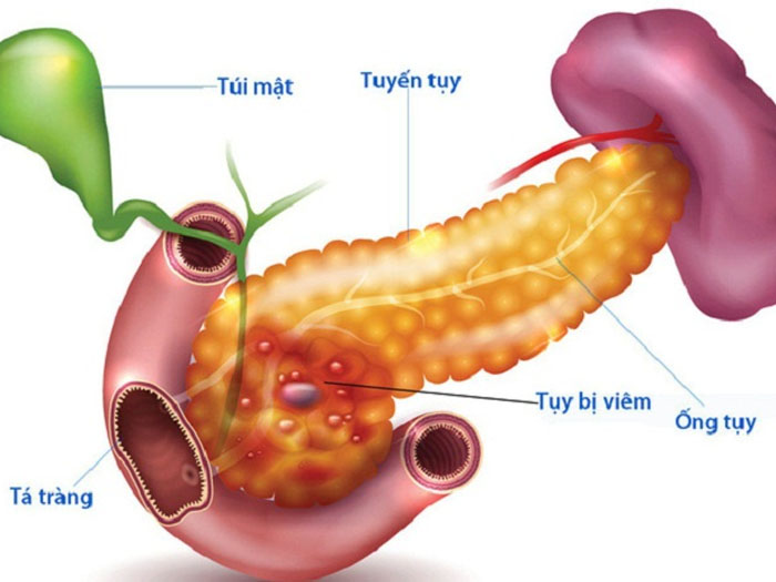 Người đàn ông 46 tuổi ở Phú Thọ mỡ máu tăng 50 lần thừa nhận có thói quen nhiều người Việt mắc phải - Ảnh 3.