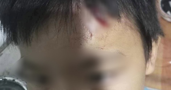 Điều tra vụ bé trai 10 tuổi nghi bị mẹ kế tiếp tục bạo hành