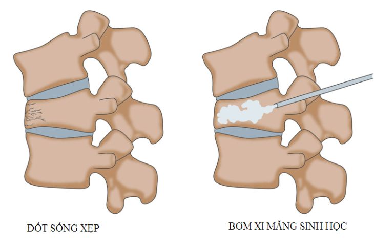 Người đàn ông 33 tuổi ở Phú Thọ dứt cơn đau cột sống nhờ cách này! - Ảnh 4. Người đàn ông 33 tuổi ở Phú Thọ dứt cơn đau cột sống nhờ cách này! - Ảnh 4.