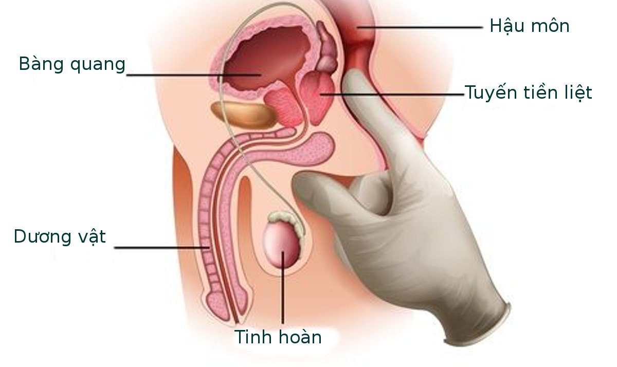 ung-thu-o-tuyen-tien-liet-17232885507111968972937-1723430534405-1723430534651432657608.jpg