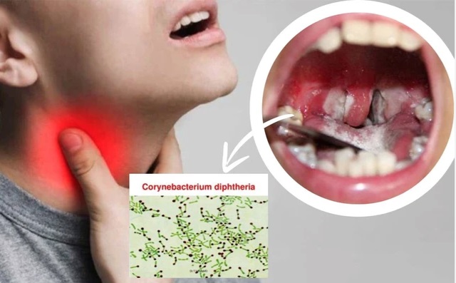 Ai có nguy cơ cao mắc bệnh bạch hầu? 5 nhóm người này cần cảnh giác - Ảnh 2.