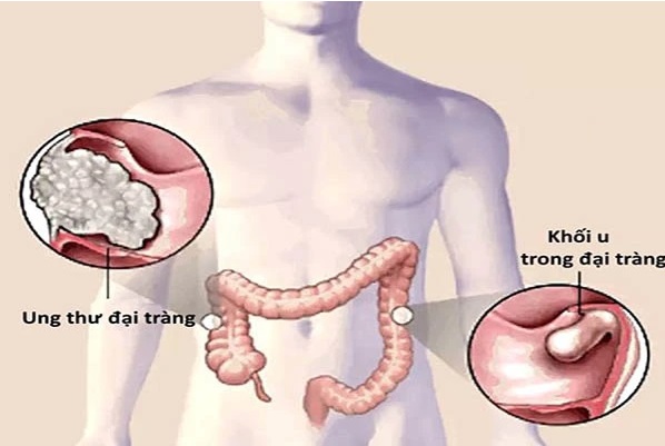 Bé gái 15 tuổi qua đời vì ung thư đại trực tràng thừa nhận giấu bố mẹ một thói quen tai hại này- Ảnh 3.