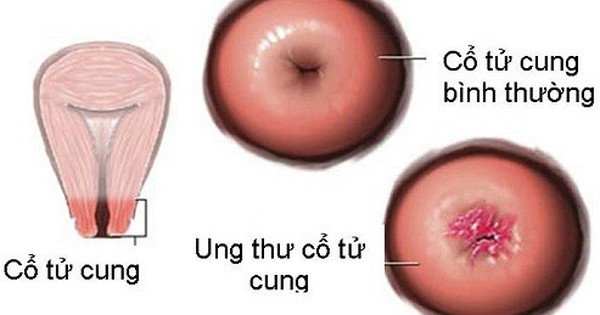 M&atilde;n kinh 5 năm vẫn ra m&aacute;u &acirc;m đạo, người phụ nữ 62 tuổi ph&aacute;t hiện ung thư tử cung - Ảnh 3.