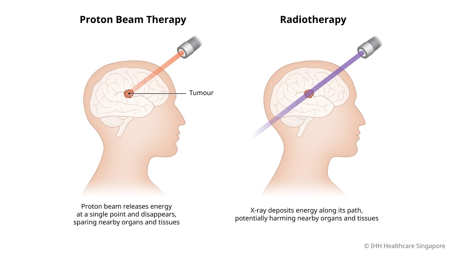 Liệu pháp nhắm trúng đích trong điều trị ung thư sử dụng độ chính xác của chùm tia proton- Ảnh 2.