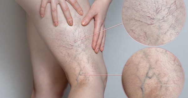 Bác sĩ cảnh báo: 80% ca huyết khối tĩnh mạch sâu không có triệu chứng, phát hiện thì đã quá muộn- Ảnh 3.