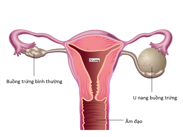 6 lý do khiến phụ nữ bị đau sau 'chuyện ấy' và cách điều trị- Ảnh 3.