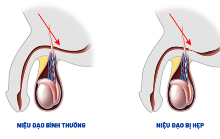 edit-edit-trieu-chung-hep-nieu-dao-17363539781351545191856-1736734239280-1736734239410248243340.jpeg