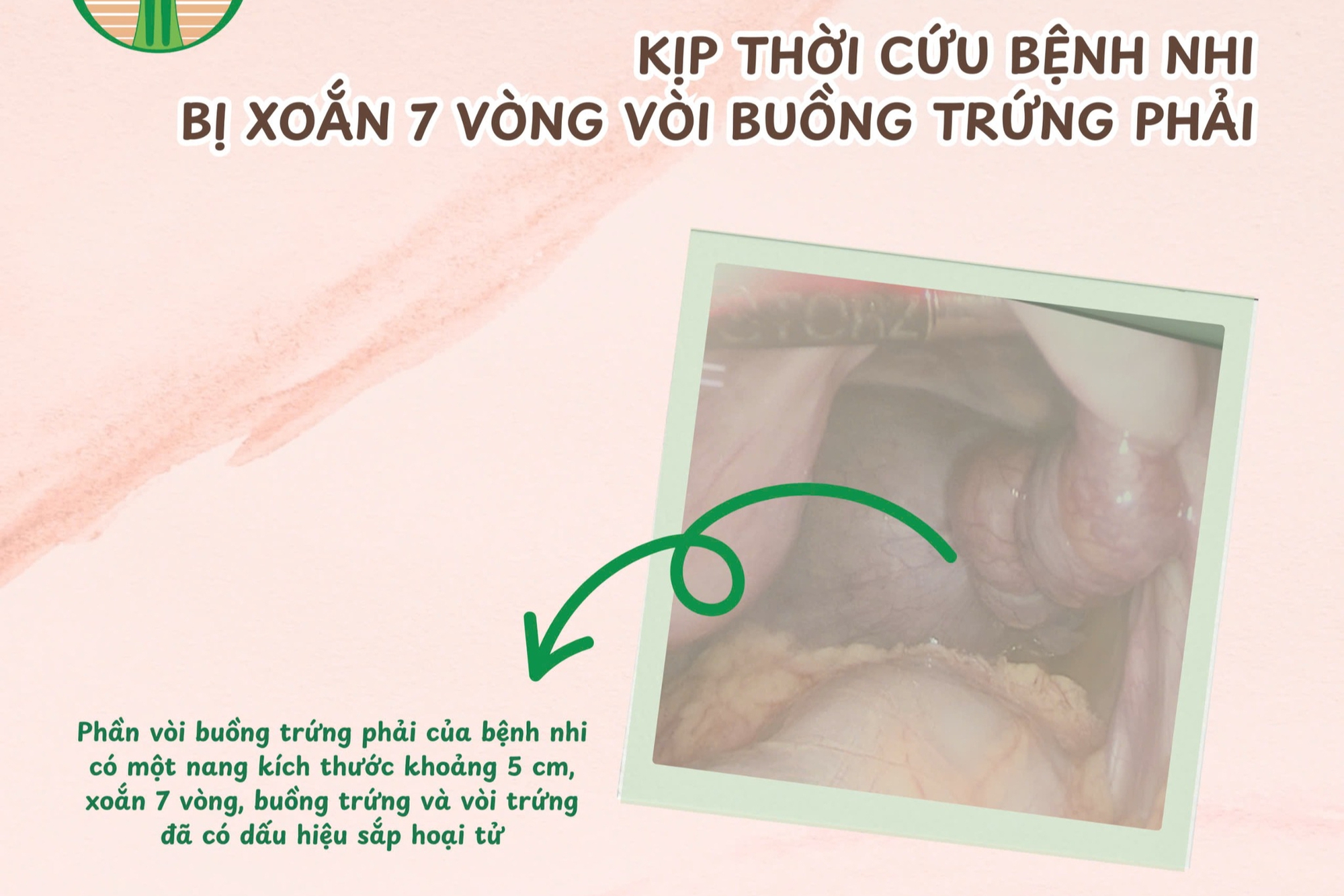Bé 13 tuổi ở Bình Dương suýt bị hoại tử buồng trứng từ dấu hiệu nhiều người Việt bỏ qua  - Ảnh 2.