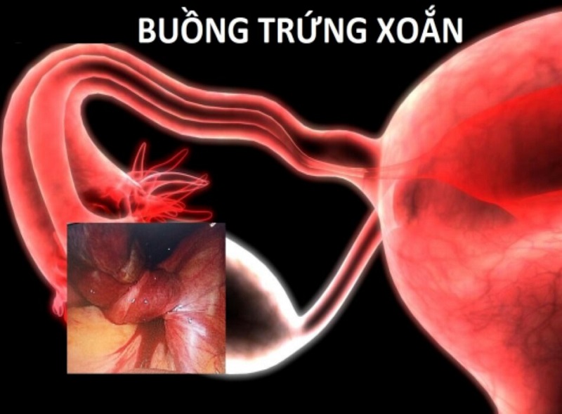 Bé 13 tuổi ở Bình Dương suýt bị hoại tử buồng trứng từ dấu hiệu nhiều người Việt bỏ qua  - Ảnh 3.