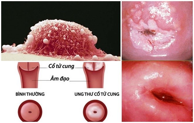 Người phụ nữ 31 tuổi ở Quảng Ninh phát hiện ung thư cổ tử cung từ dấu hiệu nhiều người Việt mắc phải - Ảnh 3.