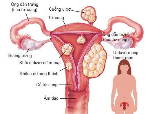 ung-thu-phu-khoa-1737531981812522227509.jpeg