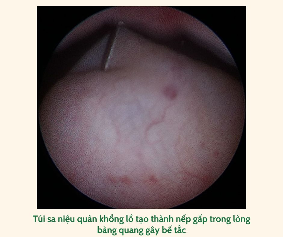 Bé 1 tháng tuổi may mắn 'thoát' khỏi khối sa niệu quản chiếm gần trọn lòng bàng quang- Ảnh 3. Bé 1 tháng tuổi may mắn 'thoát' khỏi khối sa niệu quản chiếm gần trọn lòng bàng quang- Ảnh 3.