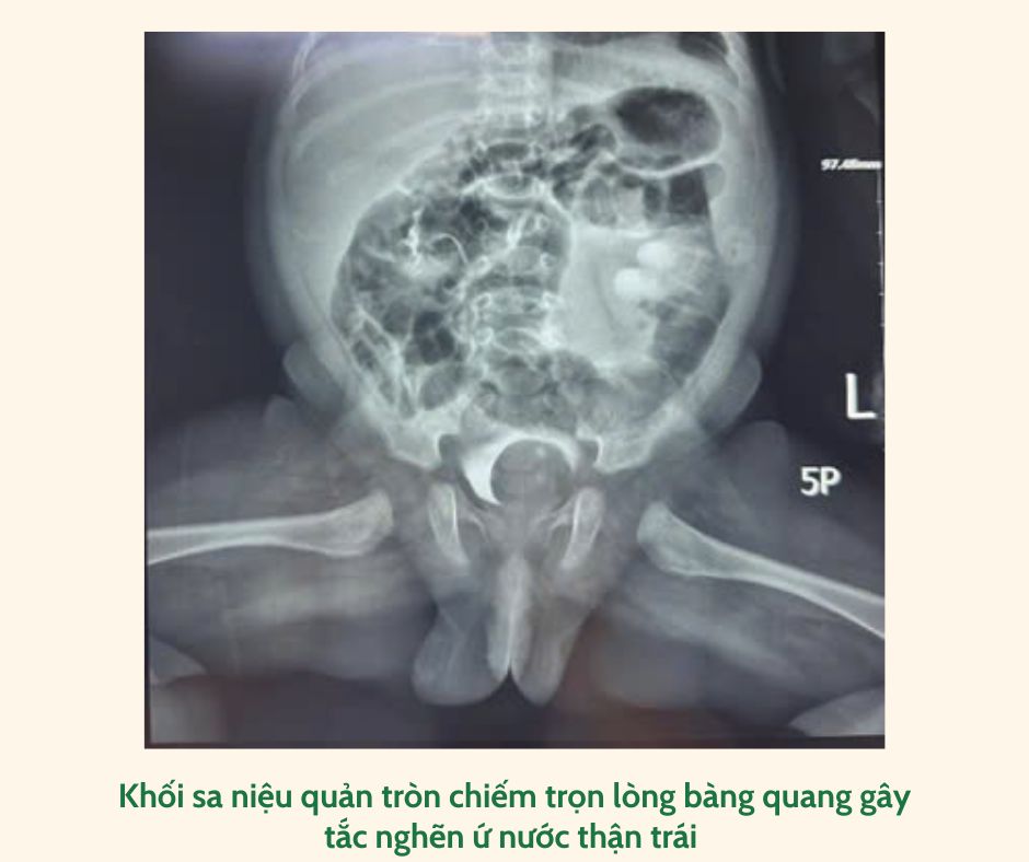 Bé 1 tháng tuổi may mắn 'thoát' khỏi khối sa niệu quản chiếm gần trọn lòng bàng quang- Ảnh 2. Bé 1 tháng tuổi may mắn 'thoát' khỏi khối sa niệu quản chiếm gần trọn lòng bàng quang- Ảnh 2.