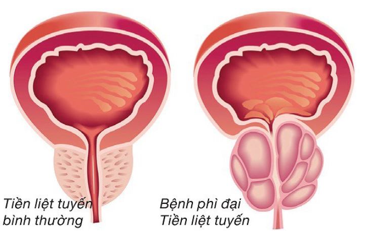 Phì đại tuyến tiền liệt và rối loạn cương dương- Ảnh 1.