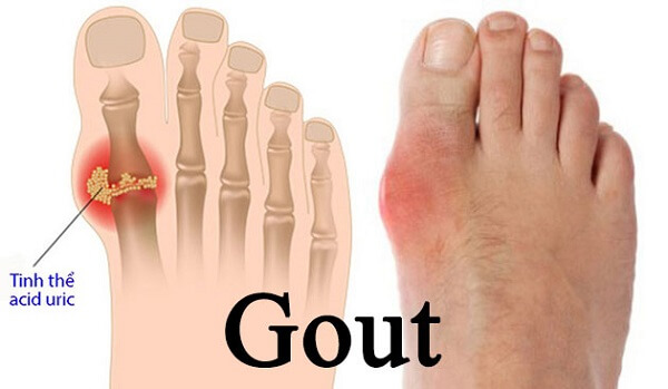 gout-cap-tinh-17378660806182106166134-1737906167593-17379061677182140587683.jpg