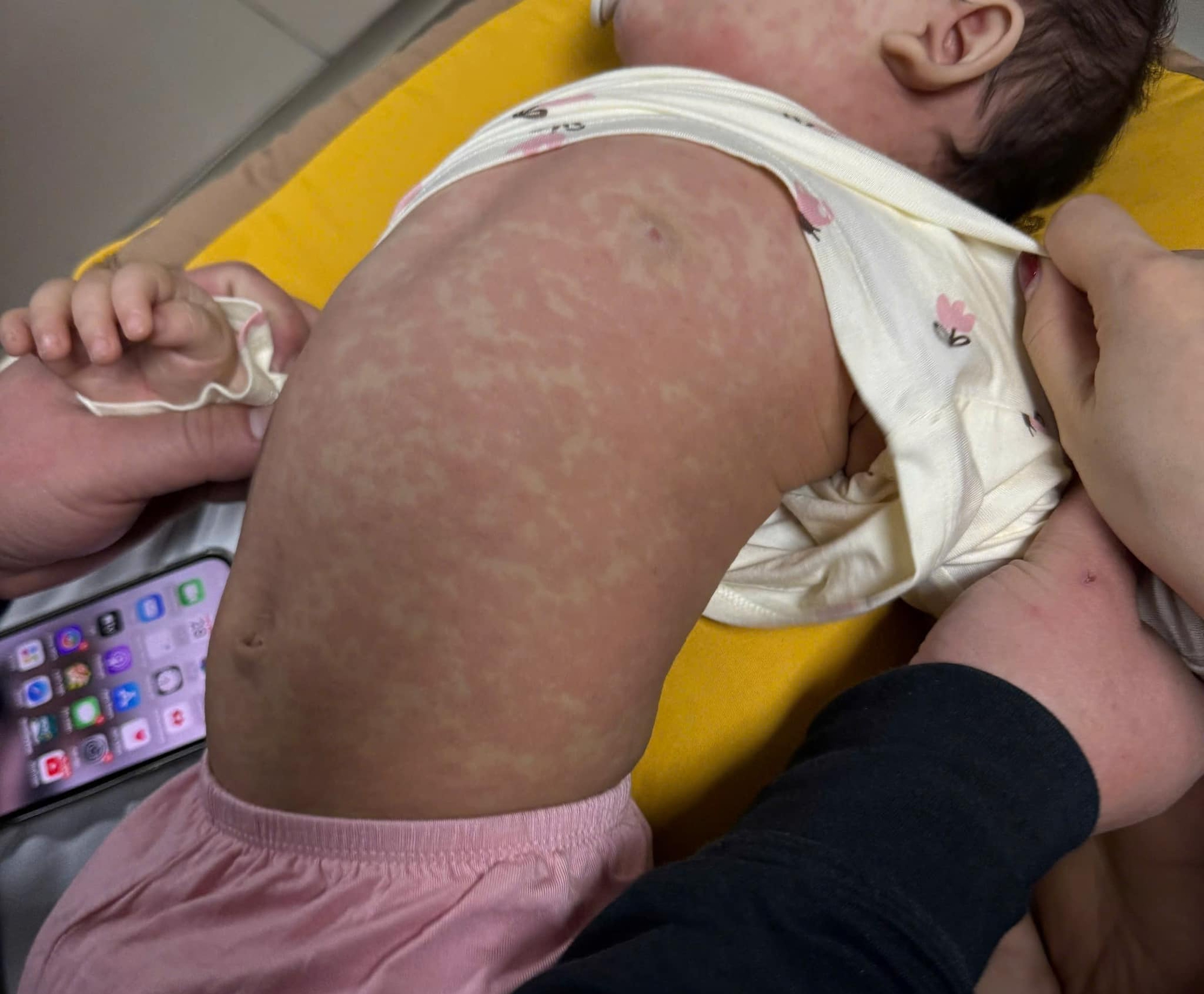 Sốt cao liên tục, ho, chảy mũi, nhiều trẻ nhập viện vì biến chứng nặng, có trẻ phải thở máy- Ảnh 1.