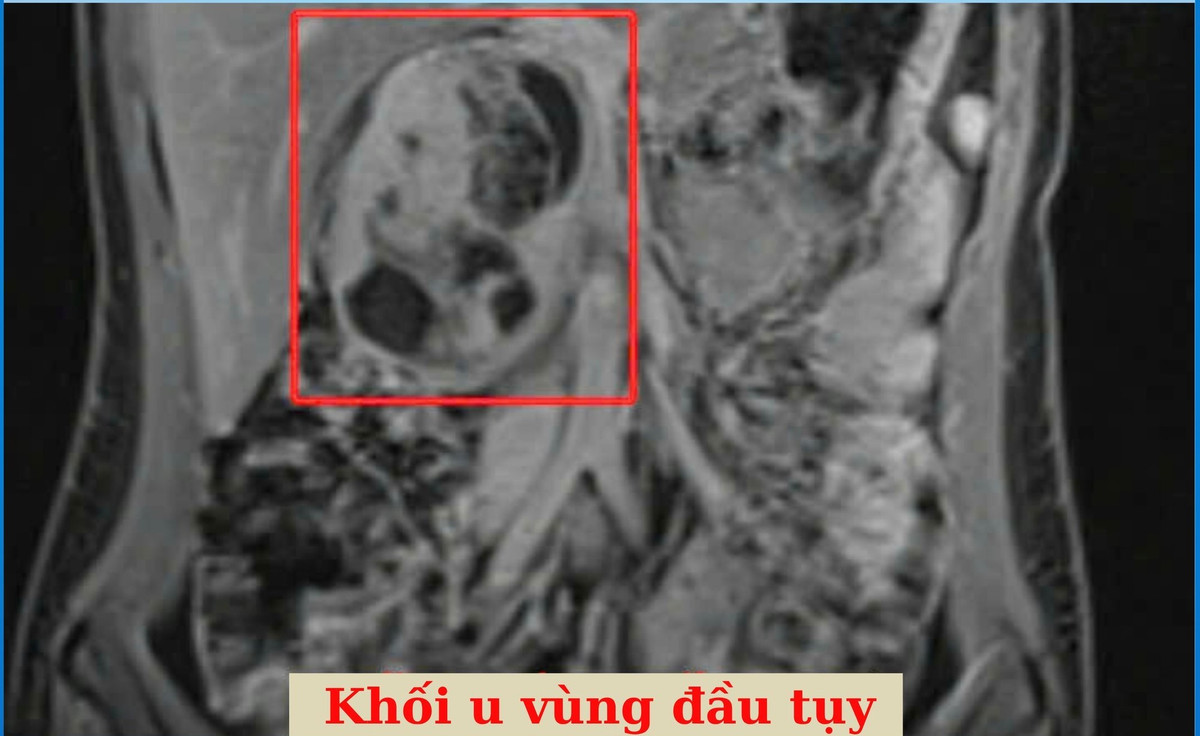 Đi khám sức khỏe định kỳ, cô gái 25 tuổi vô tình phát hiện khối u to vùng đầu tụy - Ảnh 1.