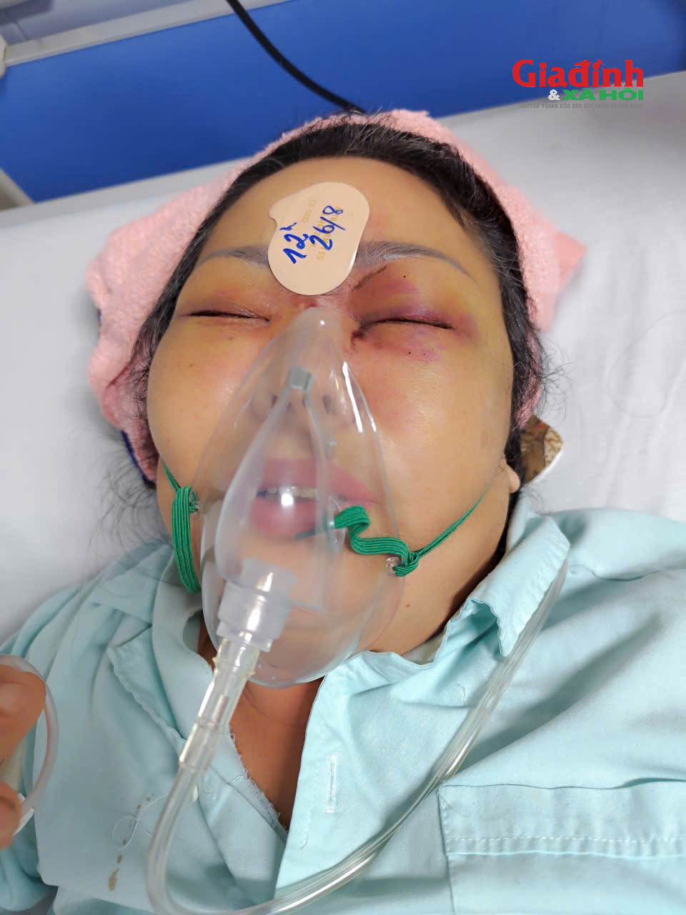 Nâng mũi phong thủy cải vận: Câu chuyện đau lòng của bà Đỗ thị Q . Tại Pusan - Ảnh 2. Nâng mũi phong thủy cải vận: Câu chuyện đau lòng của bà Đỗ thị Q . Tại Pusan - Ảnh 2.