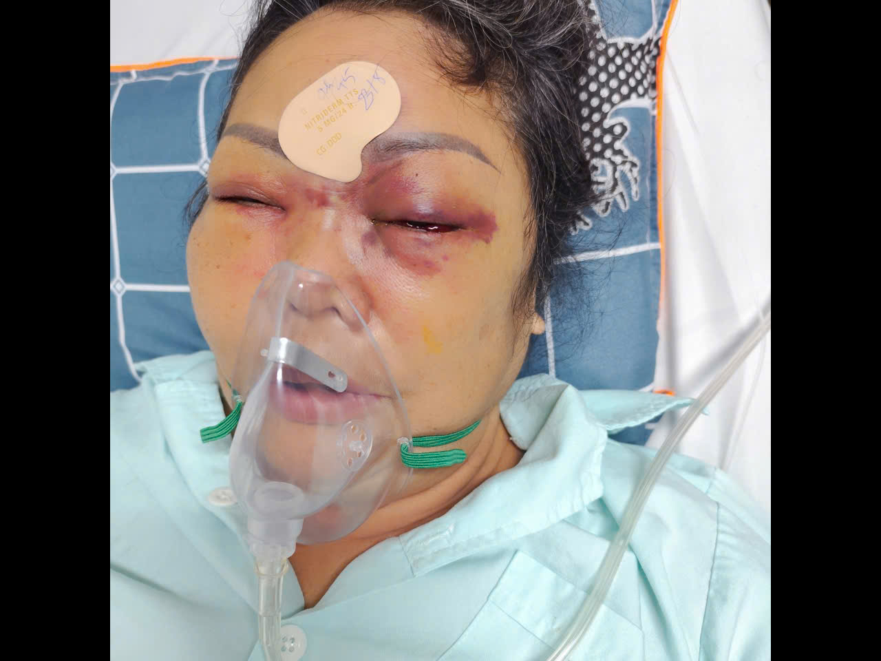 Nâng mũi cải vận nhận lại nỗi đau (bài 4): Sau tổn thương 41% cơ thể, nạn nhân tiêm filler bị mù mắt trái nhận bồi thường 250 triệu đồng để cố gắng 'giữ' mắt phải - Ảnh 1.