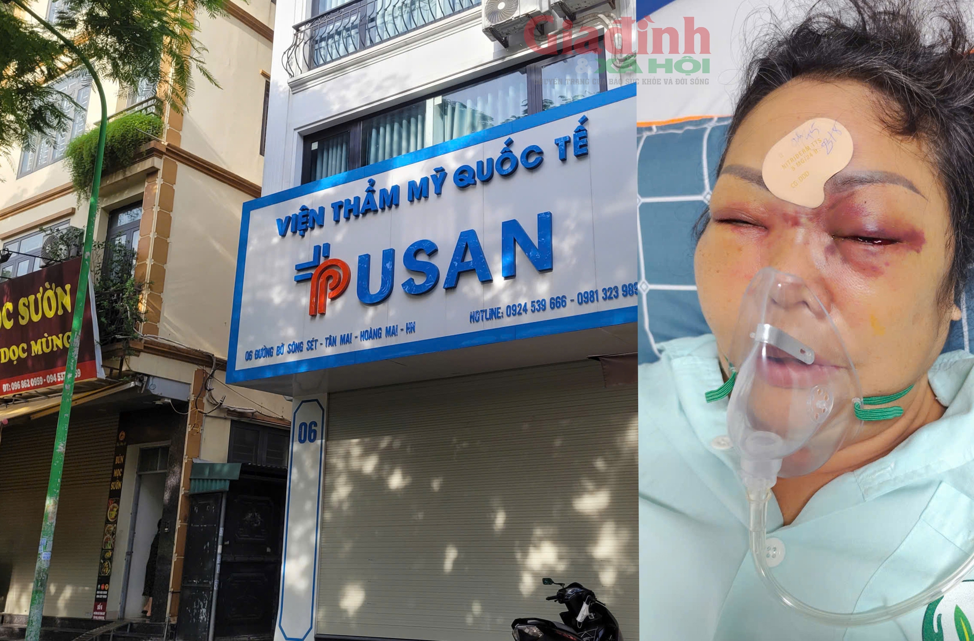 Nâng mũi cải vận và trách nhiệm của cơ sở thẩm mỹ Pusan khi gây thiệt hại - Ảnh 1.