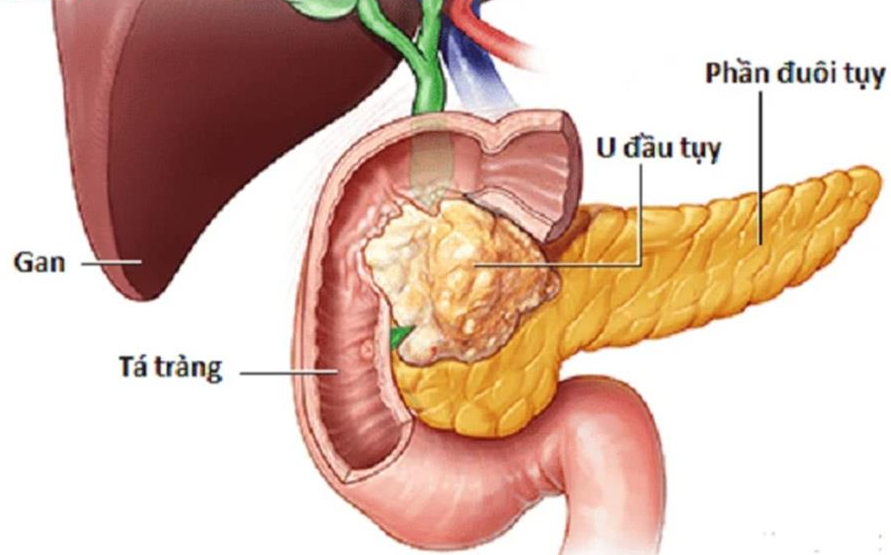 Mệt mỏi, sụt cân, người phụ nữ 65 tuổi đi khám phát hiện nổi u khắp người do mắc đa u nội tiết - Ảnh 2. Mệt mỏi, sụt cân, người phụ nữ 65 tuổi đi khám phát hiện nổi u khắp người do mắc đa u nội tiết - Ảnh 2.