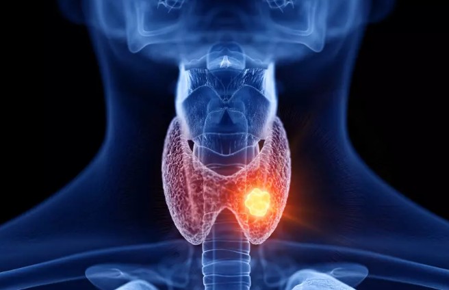 Người đàn ông mắc u tuyến giáp nhập viện gấp khi có dấu hiệu này - Ảnh 2.