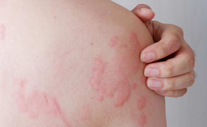 Hoa hậu H'Hen Niê bất ngờ chia sẻ mặt sưng nề, mẩn đỏ sau sinh con, căn bệnh cô mắc nguy hiểm thế nào? - Ảnh 2. Hoa hậu H'Hen Niê bất ngờ chia sẻ mặt sưng nề, mẩn đỏ sau sinh con, căn bệnh cô mắc nguy hiểm thế nào? - Ảnh 2.
