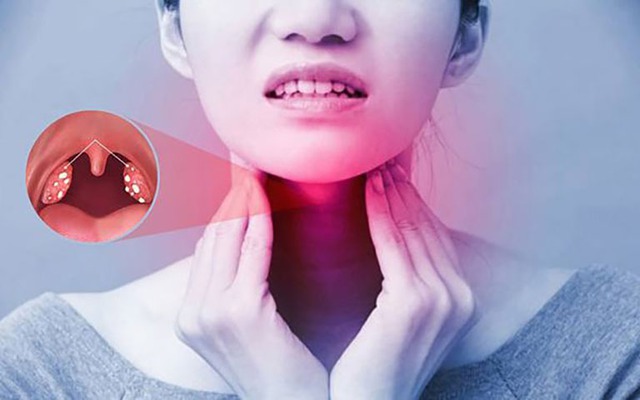 Bị viêm họng ngày lạnh, nhiều người vẫn mắc sai lầm khi ăn 5 món quen thuộc này - Ảnh 2. Bị viêm họng ngày lạnh, nhiều người vẫn mắc sai lầm khi ăn 5 món quen thuộc này - Ảnh 2.