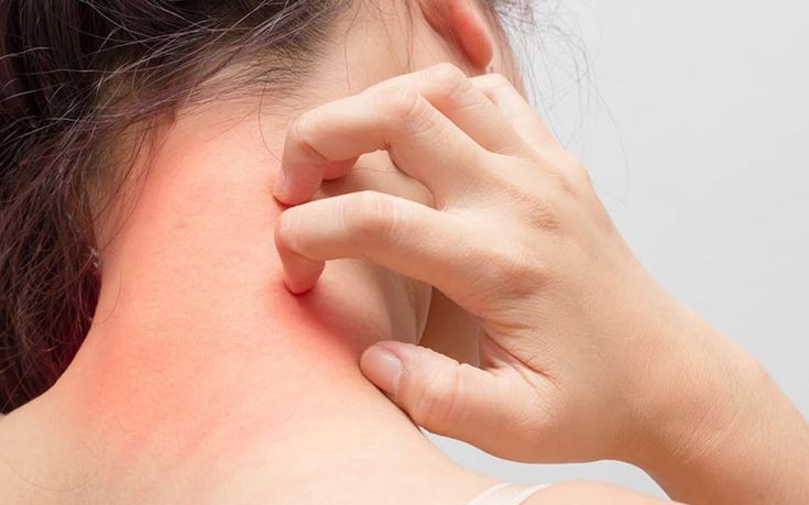 Mẹ bỉm cần cẩn trọng với mề đay sau sinh: Đừng chủ quan với những vết nổi ngứa