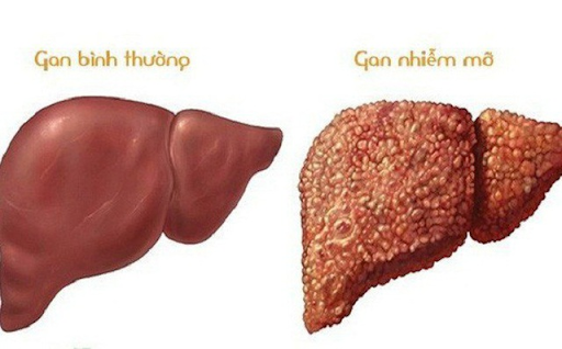 gan-nhiem-mo-1759891781191747604328.png