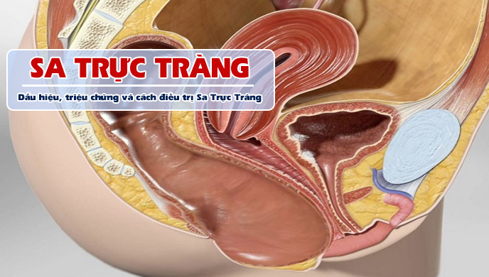 Người đàn ông 59 tuổi phát hiện sa trực tràng có dấu hiệu điển hình này! - Ảnh 2. Người đàn ông 59 tuổi phát hiện sa trực tràng có dấu hiệu điển hình này! - Ảnh 2.