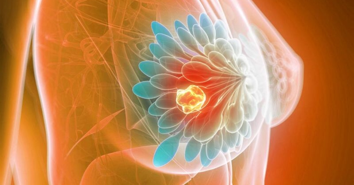 Phát hiện sớm ung thư vú nhờ ứng dụng AI trong chụp nhũ ảnh tầm soát- Ảnh 3. Phát hiện sớm ung thư vú nhờ ứng dụng AI trong chụp nhũ ảnh tầm soát- Ảnh 3.