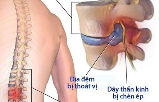 Thoái vị đĩa đệm cột sống lưng: Cần làm gì để hết đau? - Ảnh 2. Thoái vị đĩa đệm cột sống lưng: Cần làm gì để hết đau? - Ảnh 2.