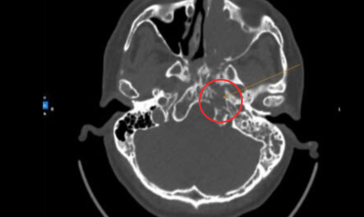 Người đàn ông 58 tuổi phát hiện ung thư hốc mũi từ dấu hiệu nhiều người Việt bỏ qua - Ảnh 2.