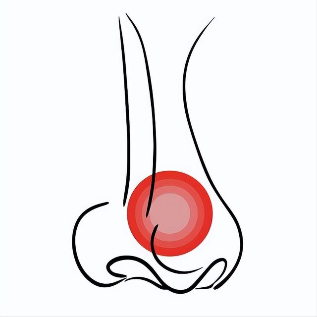 Nghẹt mũi nặng, khó thở không hẳn là cảm lạnh - có thể bạn đã bị viêm xoang! 3 thói quen khiến bệnh dễ &quot;ghé thăm&quot; - Ảnh 3.