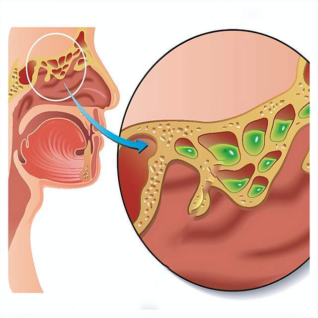Nghẹt mũi nặng, khó thở không hẳn là cảm lạnh - có thể bạn đã bị viêm xoang! 3 thói quen khiến bệnh dễ &quot;ghé thăm&quot; - Ảnh 2.