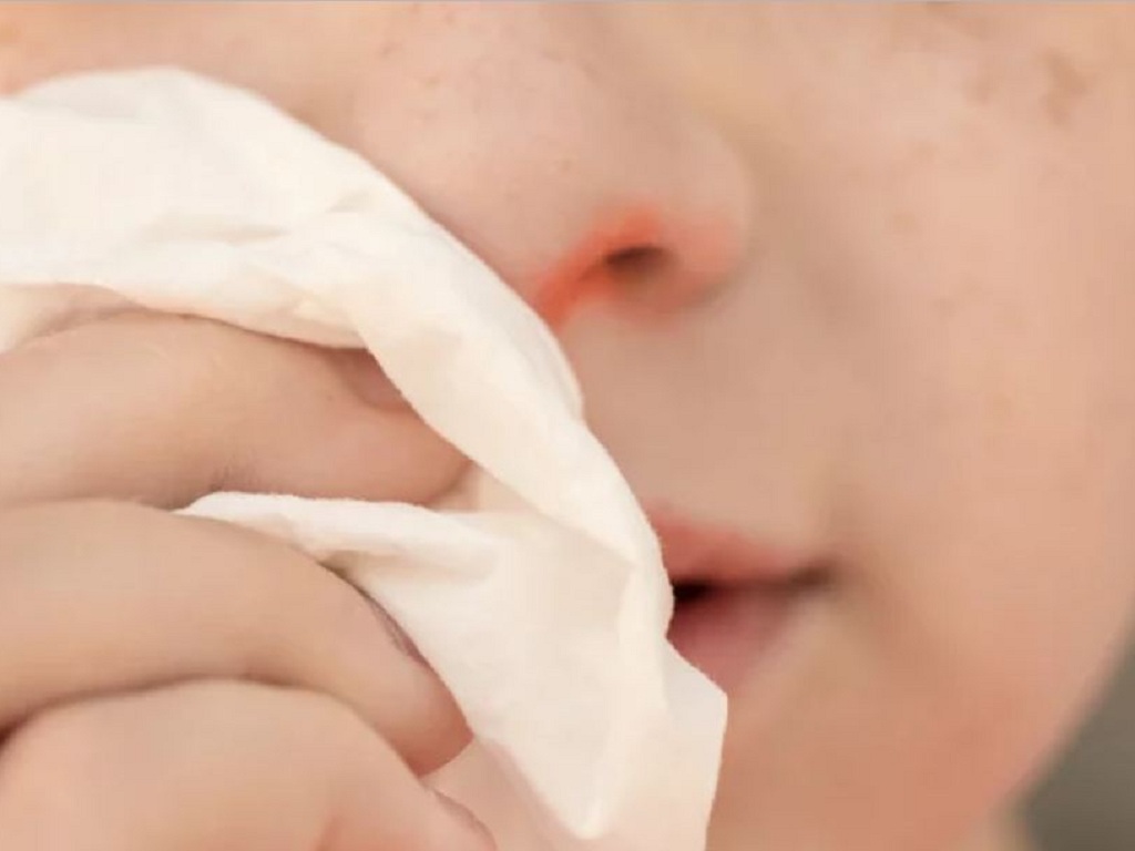 Khô mũi, chảy máu mũi trong ngày hanh khô: Cách chăm sóc và ngăn ngừa hiệu quả - Ảnh 1.