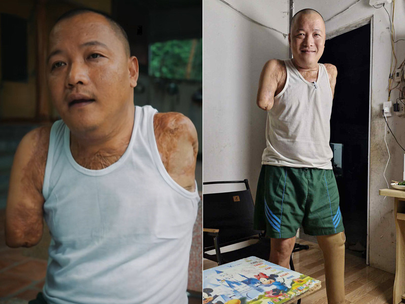 Mất 2 tay 1 chân sau tai nạn, người đàn ông tìm lại cuộc đời nhờ tình yêu của vợ - Ảnh 1.