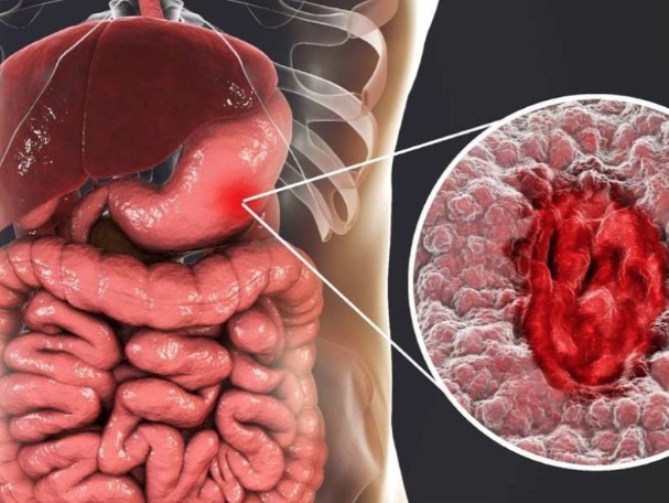 Người phụ nữ 41 tuổi phát hiện ung thư dạ dày từ dấu hiệu rối loạn tiêu hóa mà người Việt thường bỏ qua - Ảnh 3. Người phụ nữ 41 tuổi phát hiện ung thư dạ dày từ dấu hiệu rối loạn tiêu hóa mà người Việt thường bỏ qua - Ảnh 3.