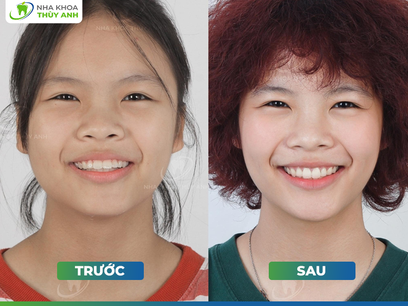 Hành trình kết nối nụ cười của bác sĩ Phương Thảo tại nha khoa Thùy Anh - Ảnh 4. Hành trình kết nối nụ cười của bác sĩ Phương Thảo tại nha khoa Thùy Anh - Ảnh 4.