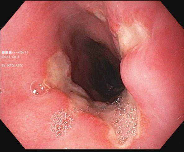 Bác sĩ bất ngờ khi thấy thực quản bệnh nhân loét nặng: 'Thủ phạm' là sai lầm nhiều người Việt mắc - Ảnh 1. Bác sĩ bất ngờ khi thấy thực quản bệnh nhân loét nặng: 'Thủ phạm' là sai lầm nhiều người Việt mắc - Ảnh 1.