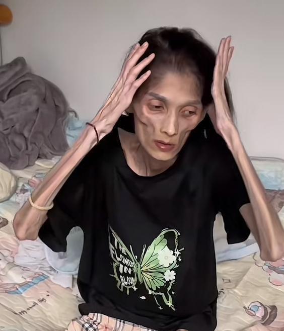 Bệnh g&igrave; khiến người phụ nữ 27 tuổi cao 1,6m nhưng chỉ nặng 17,5kg bị "teo dạ d&agrave;y" v&agrave; qua đời: BS khuyến c&aacute;o loại vi khuẩn c&oacute; li&ecirc;n quan - Ảnh 2.