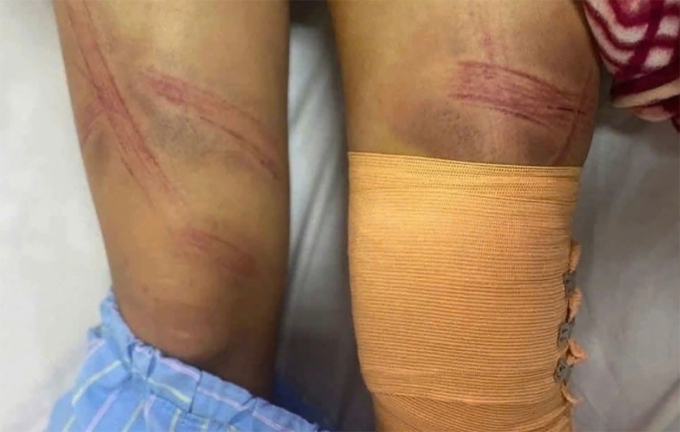 B&eacute; g&aacute;i 12 tuổi bị bố đ&aacute;nh nhập viện - Ảnh 1.