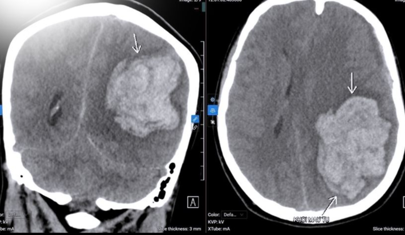 Cô gái 22 tuổi bị đột quỵ xuất huyết não, từng xuất hiện dấu hiệu này nhưng đã bỏ qua - Ảnh 1.